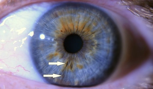 Diagnostika z očnej zreničky - genetické oslabenie