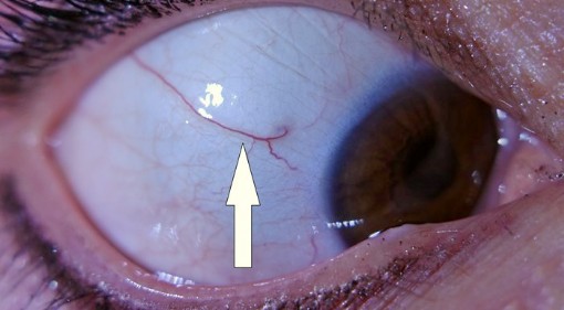 Diagnostika z očného bielka, "dynamická" cieva - poškodenie pohybového aparátu